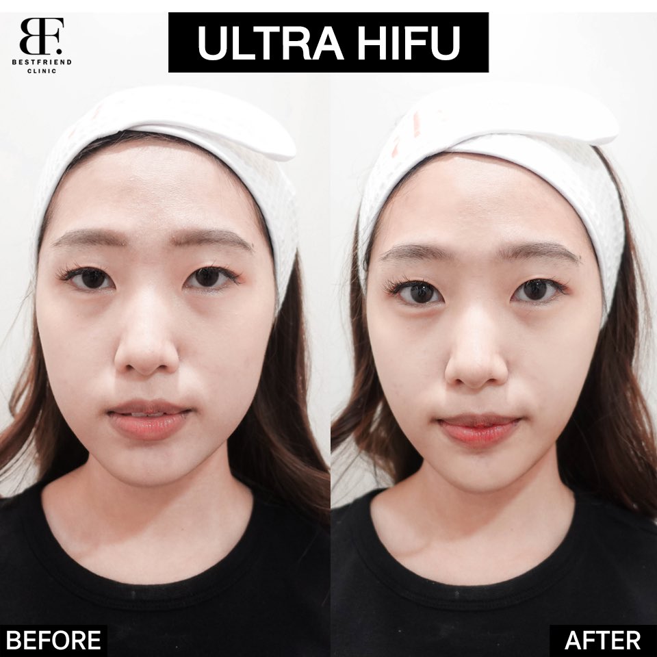 bf_clinic's tweet photo. ยกกระชับ หน้า+เหนียง ไม่จำกัด shot

🔥Ultra Hifu เพียง 2,999.-🔥

✔️ผิวกระชับขึ้นทันทีหลังทำ
✔️เห็นผลชัดเจนหลังทำ 1 เดือน
✔️ช่วยกระตุ้น Collagenใต้ชั้นผิว
✔️สลายไขมันใต้ชั้นผิว

#หน้าใส #ลดไขมัน #หน้าเรียว #ลดริ้วรอย #คลินิก #เอกมัย #howtoperfac https://t.co/5ZyUa4sZfR