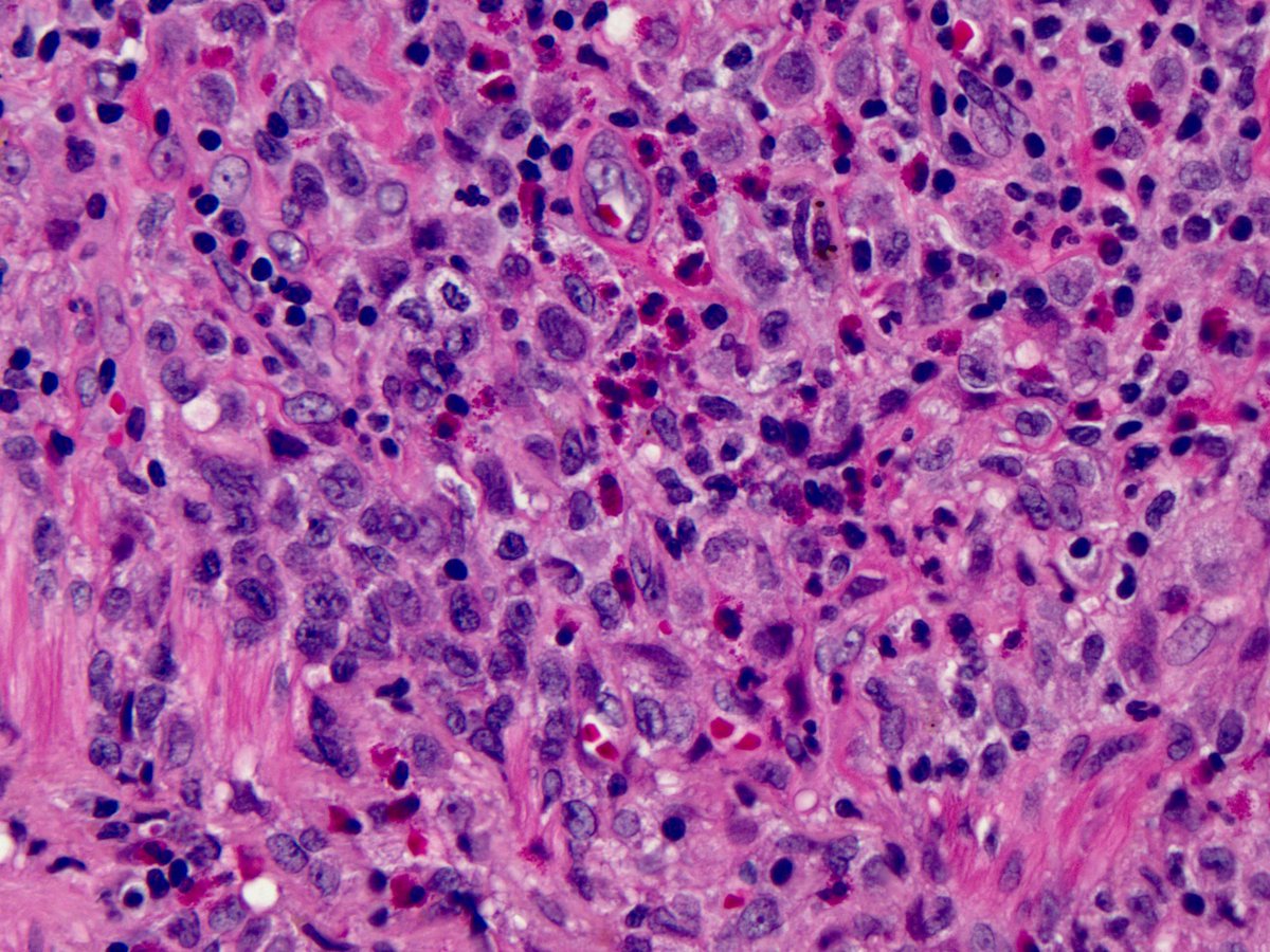 This is classic pulmonary Langerhans cell histiocytosis:1. mm-size stellate nodules, sheets of Langerhans cells, eos 2. All the findings I posted before are distractors. 3. “Vasculitis” is common in PLCH, can look much worse than this 4. The “NSIP” pic is SRIF (needs skill)
