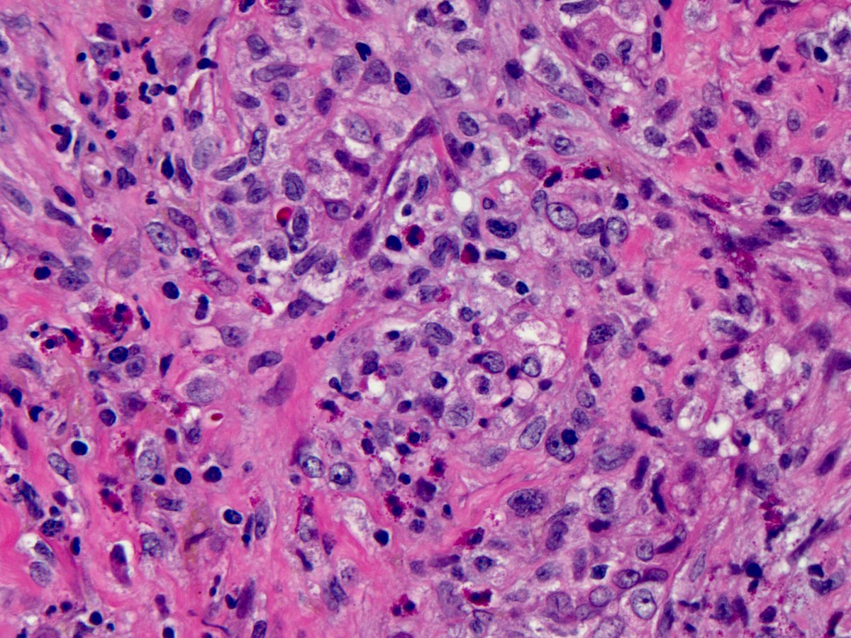 This is classic pulmonary Langerhans cell histiocytosis:1. mm-size stellate nodules, sheets of Langerhans cells, eos 2. All the findings I posted before are distractors. 3. “Vasculitis” is common in PLCH, can look much worse than this 4. The “NSIP” pic is SRIF (needs skill)