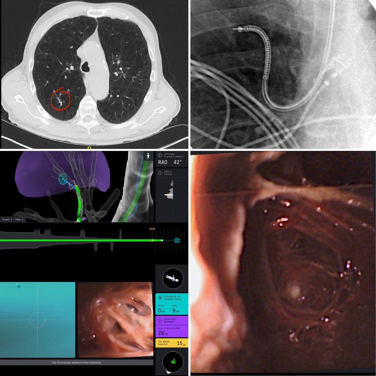 A whole new world! Peaking inside a 9mm peripheral lesion with a hidden internal cavity, using the Ion robotic bronchoscopy platform. With <a href="/pulmo_dok/">Napoleon Puente</a>