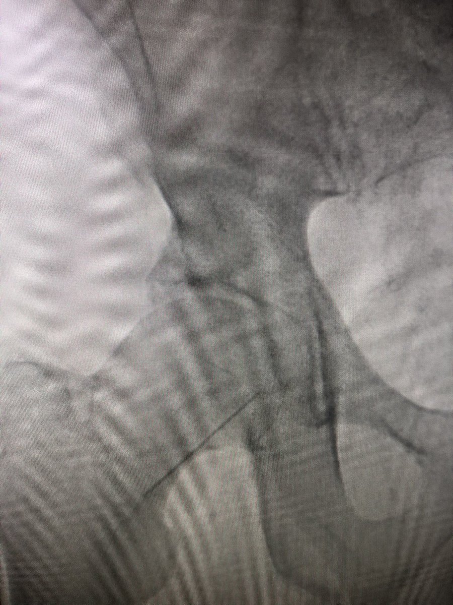 Step 2 -  #UltrasoundAccess to identify common femoral and calcification (not shown) . Be above the femoral bifurcation. Insert micro puncture needle to access but not puncture the artery. Quick fluoro check to make sure puncture will be in  #SafeZone. (Shown)  #JointCathConference