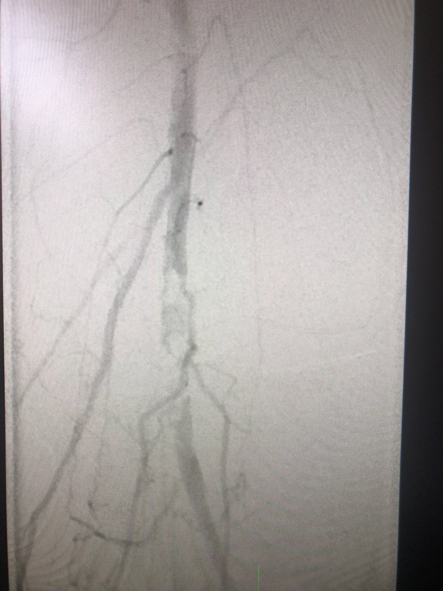 Step 5 - tackle the task at hand! In this case a complicated restenosis of a mixed plaque of popliteal artery. Having had good access - you have piece of mind in proceeding with high quality intervention.  #PeripheralIntervention  #JointCathConference
