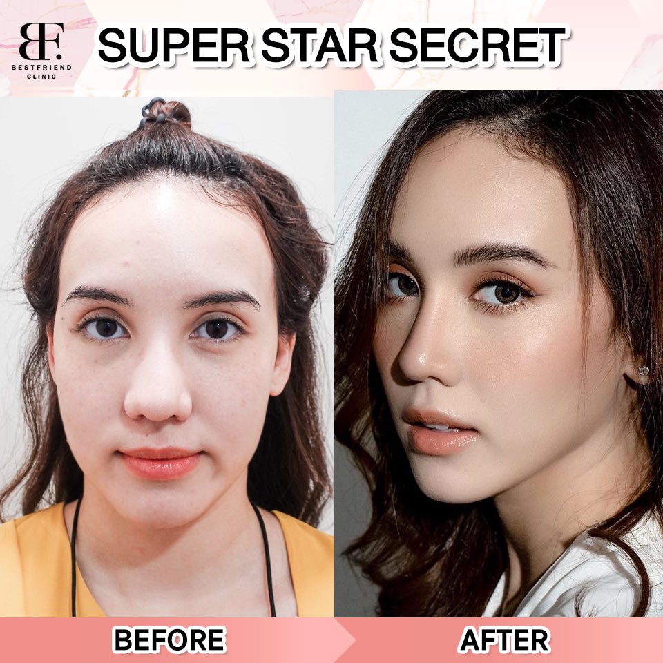 bf_clinic's tweet photo. ✨ผิวนุ่ม หน้าใส ✨
#Super Star Secret

✔️หน้ากระจ่างใส
✔️รักษาสมดุลผิว
✔️ลดริ้วรอย จุดด่างดำ ฝ้า กระ
✔️ยับยั้งการสร้างเม็ดสีเมลานิน
✔️ฟื้นฟูถึงระดับเซลล์ผิว
✔️ผิวนุ่ม ชุ่มชื้น
✔️เรียบเนียน รูขุมขนกระชับ

#หน้าใส #ลดไขมัน #หน้าเรียว #ลดริ้วรอย #คลินิก #เอกมัย #howtoperfac https://t.co/Y2MDXUiZuP