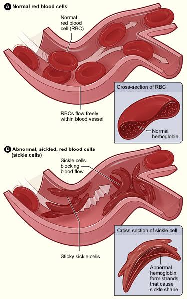 The flexible nature of the BBC allows it carry oxygen to different parts of the body.• What Is SICKLE CELL?- It's an inherited disorder that makes RBC to be shaped like a "Sickle" and rigid.- It's inherited because each parent donates 1 genotype each to form the child's own