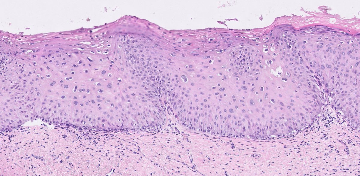 Two questions on this biopsy:1. Would your interpretation differ based on the anatomical location of the biopsy? (i.e. would you call it the same irrespective from where the biopsy was taken?)2. Would you ask for p16 IHC? #pathology  #IHCpath