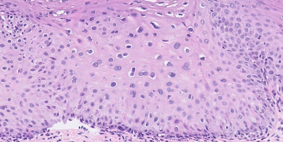 Two questions on this biopsy:1. Would your interpretation differ based on the anatomical location of the biopsy? (i.e. would you call it the same irrespective from where the biopsy was taken?)2. Would you ask for p16 IHC? #pathology  #IHCpath