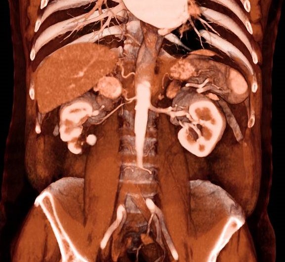 Feocromocitoma suprarrenal derecho #UroFJD #UroSoMe #Urologyweek
