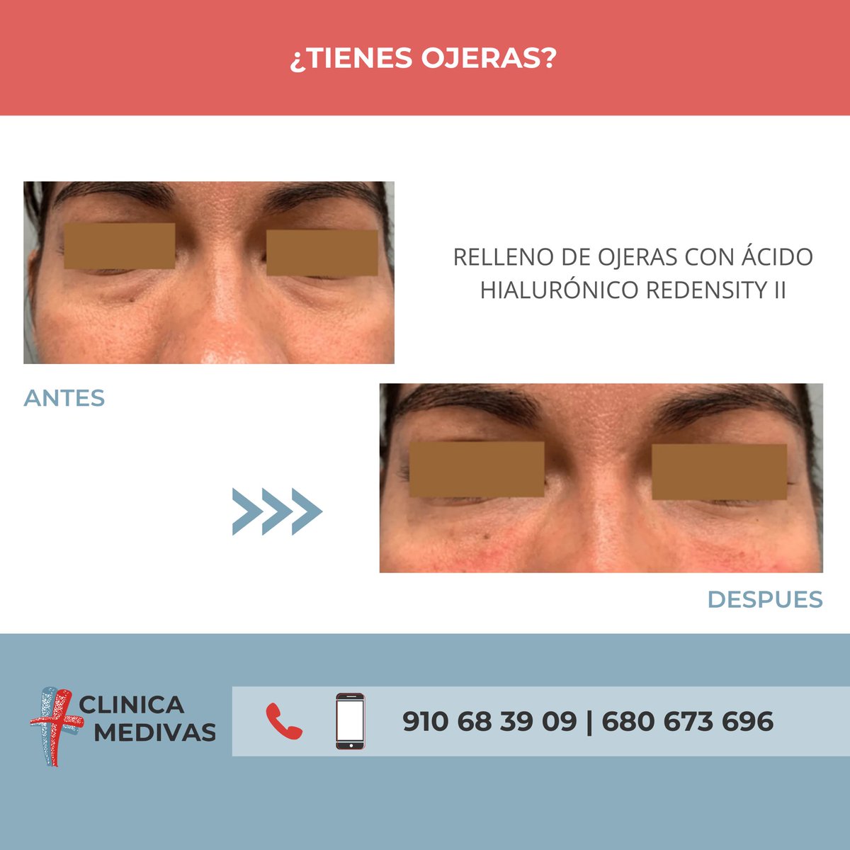 clinicamedivas's tweet photo. ¿Tienes ojeras hundidas? 🍂El relleno con ácido hialurónico puede ser la solución a tu problema. #CLINICAMEDIVAS #MEDIVAS 

Consúltanos:

📞 910 068 39 09 / 680 673 696
📩 info@clinicamedivas.net
📍C/Principe de Vergara 57-59, Madrid, España
📌 https://t.co/HSyS4aqzy3 https://t.co/DMoA79zKs6