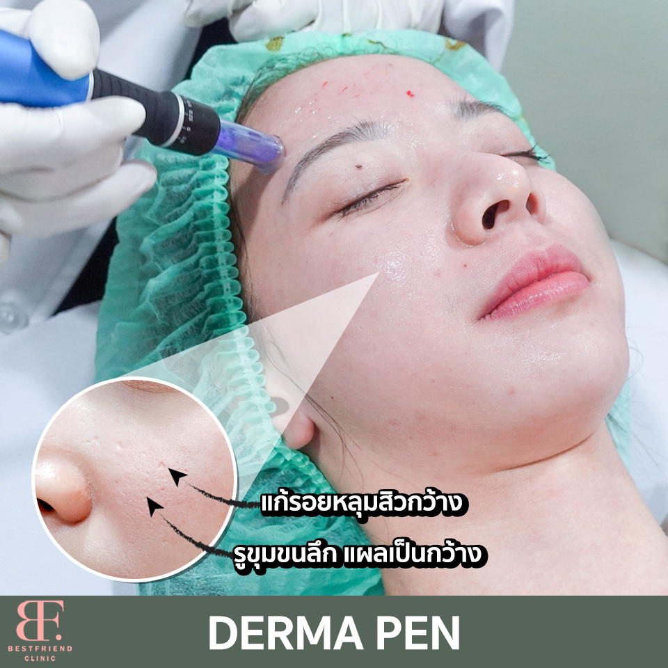 bf_clinic's tweet photo. 💛หลุมสิว รูขุมขนกว้าง ผิวไม่เรียบเนียน💛
จัดการด้วย #DERMAPEN

✔️กระตุ้นคอลลาเจน
✔️รูขุมขนเล็กลง
✔️แผลเป็น หลุมสิวตื้นขึ้น
✔️หน้าเรียบเนียน กระจ่างใส

#หน้าใส #ลดไขมัน #หน้าเรียว #ลดริ้วรอย #คลินิก #เอกมัย #howtoperfact https://t.co/LpBxrsAuki