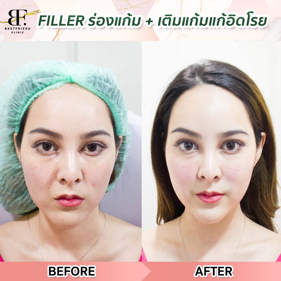 bf_clinic's tweet photo. ตัวช่วยความอ่อนเยาว์ เปลี่ยนหน้าโทรม เป็นหน้าสวย ด้วย #Filler แก้ม

✔️เห็นผลทันทีหลังทำ
✔️การรักษาอยู่ได้นาน 8-10 เดือน
✔️ฟิลเลอร์แท้แน่นอน ไม่เป็นอันตราย 💯
✔️แก้ปัญหาแก้มตอบ ร่องแก้มน้ำหมาก

#หน้าใส #ลดไขมัน #หน้าเรียว #ลดริ้วรอย #คลินิก #เอกมัย #ราคาถูก #howtoperfact https://t.co/D21ee12lYH