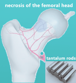 ctod_editor's tweet photo. #CTOD [Study Protocol] Porous tantalum rods improve the hip joint function of patients with avascular necrosis of the femoral head after femoral neck fracture surgery: study protocol of a randomized controlled trial
#fracture #hipjoint #necrosis #material

https://t.co/aJBK1h7Ce3 https://t.co/89IVVO9CHA