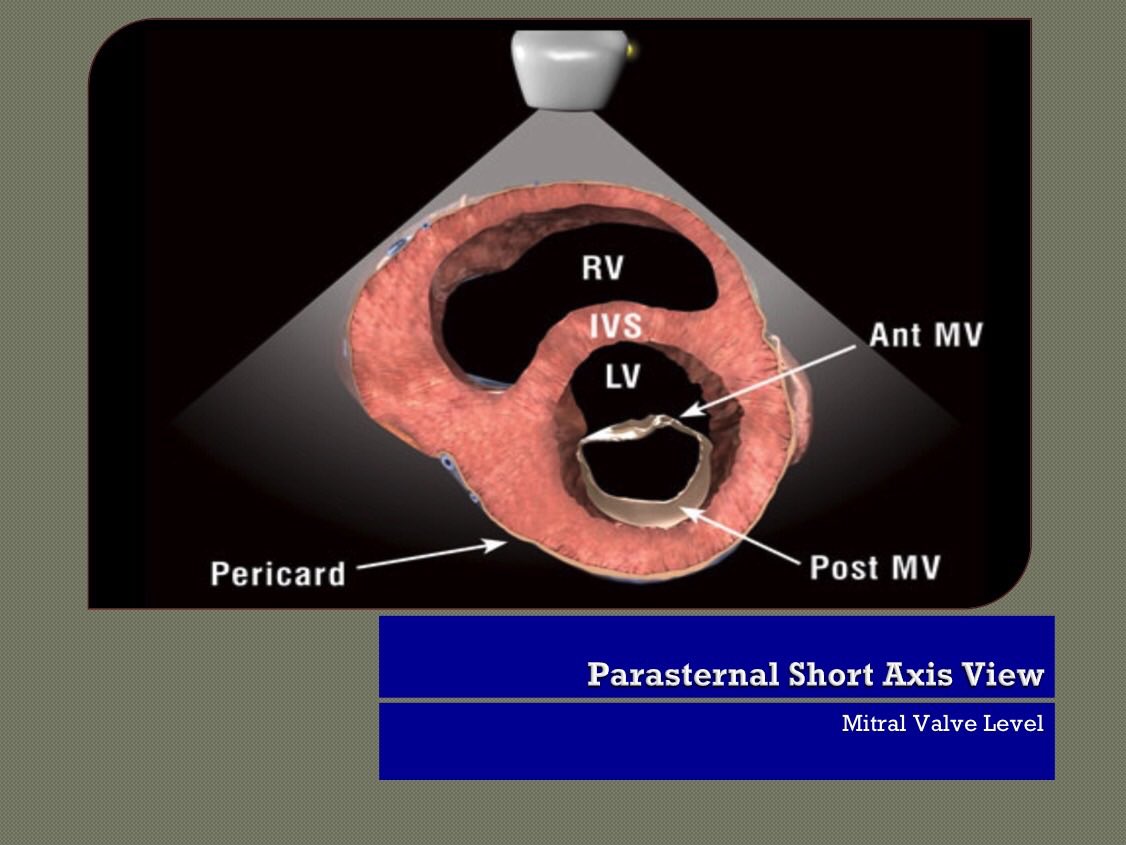 MedInterestGrp's tweet photo. Bedside Echo-Parasternal Short Axis Views https://t.co/4xYpHXevHT