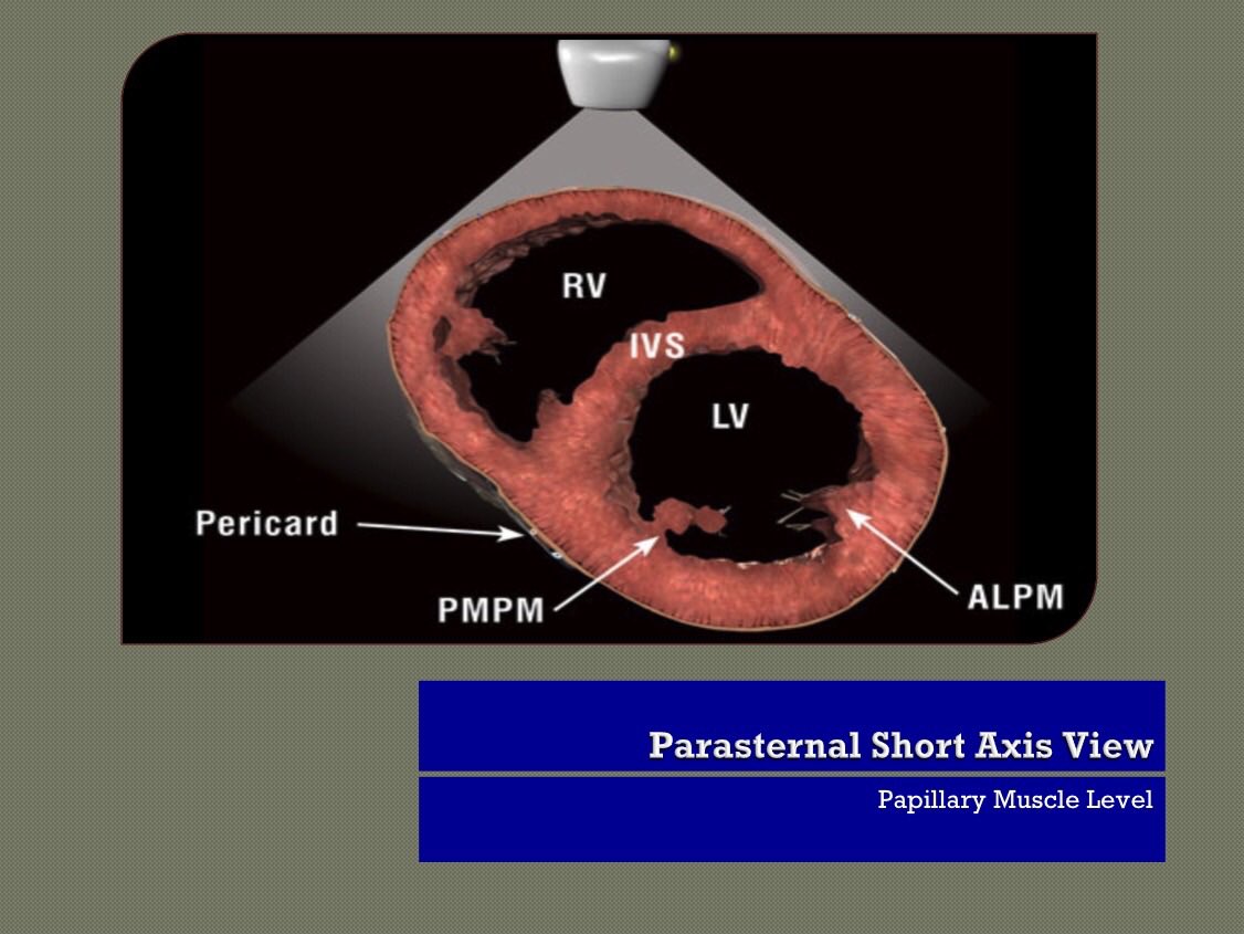 MedInterestGrp's tweet photo. Bedside Echo-Parasternal Short Axis Views https://t.co/4xYpHXevHT