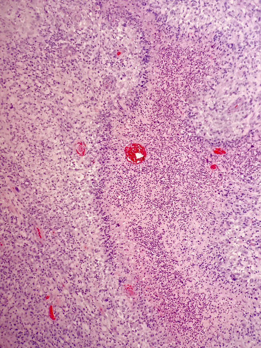 martinwpath's tweet photo. Gliosarcoma- Biphasic variant of glioblastoma with alternating glial and mesenchymal differentiation. Tumors have traditional features of GBM including palisading necrosis, microvascular proliferation, and high mitotic rate with additional sarcomatoid features. WHO grade IV. https://t.co/cKwhOdDPYL