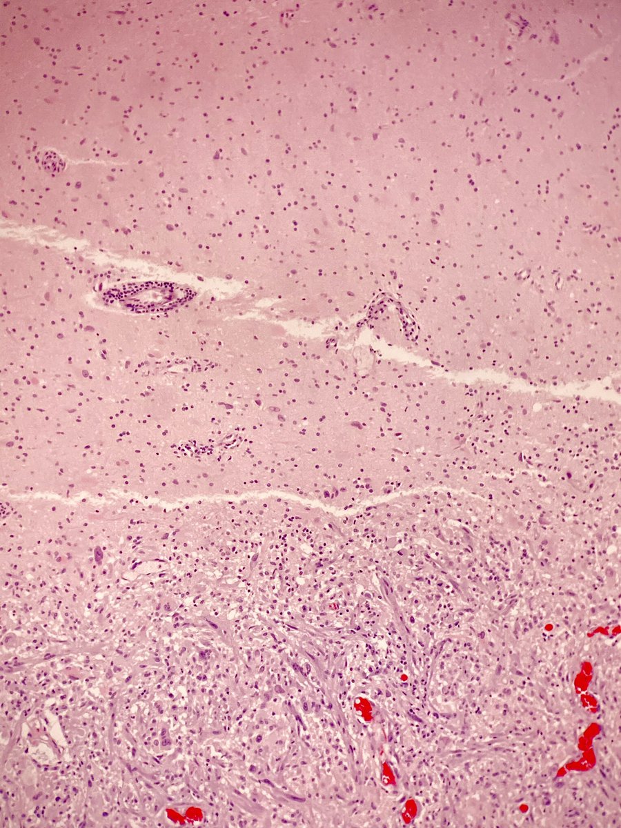 martinwpath's tweet photo. Gliosarcoma- Biphasic variant of glioblastoma with alternating glial and mesenchymal differentiation. Tumors have traditional features of GBM including palisading necrosis, microvascular proliferation, and high mitotic rate with additional sarcomatoid features. WHO grade IV. https://t.co/cKwhOdDPYL
