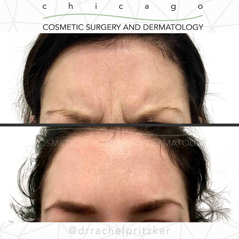 Chicagoderm's tweet photo. #BeforeAndAfter 😲➡️😍
💉Results after one #Dysport treatment by #DrRachelPritzker!
.
🚨Only a few spots left for NEW to Dysport patients this week!
☎️Call our office to #schedule your appointment.
📲312-245-9965 option 2
.
#chicagodermatology #chicago #dermatology #cosmetic https://t.co/Jk2BzxKMGi