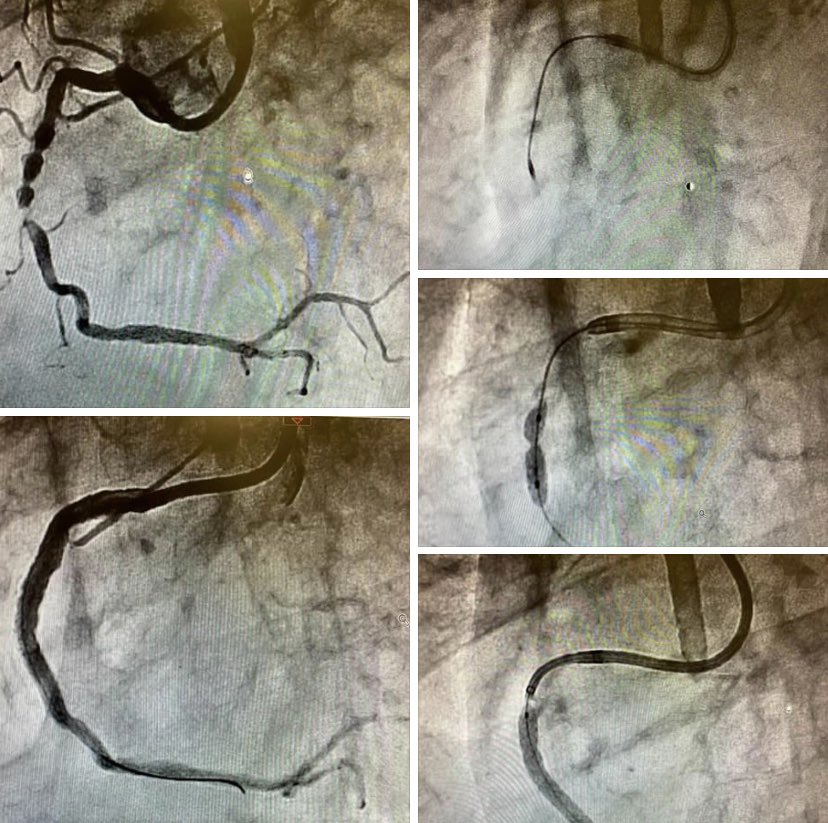 All our possibile tools to treat a severely calcified non crossable and non dilatable lesion: Rotablator, Shockwave and Guide Extension Catheter. Rimini Cath Lab.