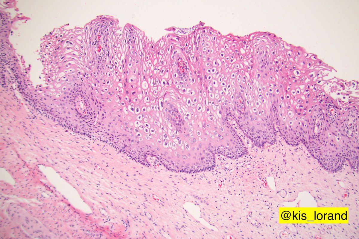 8/ proteins that are expressed and incorporated in the virions, such as the VCA-viral capsid antigen shown on a different case the staining is limited to the superficial part of the epithelium because at this level is the viral protein expressed ...