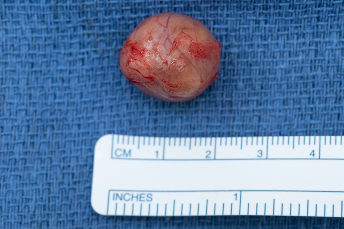 A top tier athlete with a #schwannoma in lower leg, before and after.
#anatomy #microsurgery #plasticsurgery #neurosurgery #neuro #neurology #operatingroom #peripheralnervetumor #neurofibroma #tumor #schwannoma #schwannomatosis #handsurgery #brachialplexus #nervetumor #nerve