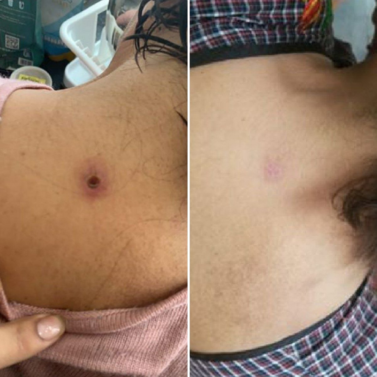 aracelideanda's tweet photo. #ReseñasChingonas usaron #KLMC y #Pretty de #MenjurjesChingones es un piquete de zancudo que se infectó 😱😱😱 @MenjurjesChing1 https://t.co/gN5yVirtLL