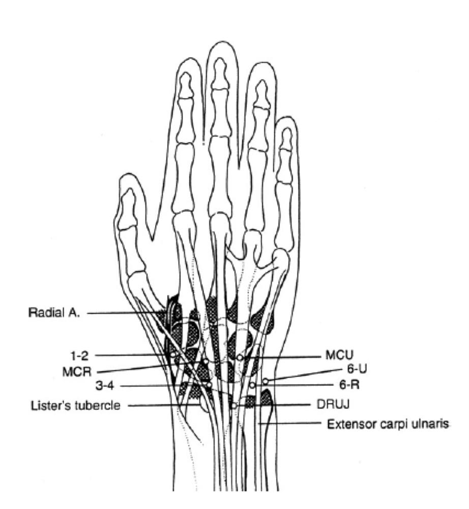 orthobullets's tweet photo. Wrist arthroscopy has important diagnostic/therapeutic roles in wrist injuries but has a 2% complication rate. 1-2 portal is placed b/w ECRB &amp; APL. Care must be taken due to reported injuries to superficial branch of the radial nerve &amp; radial artery. More: https://t.co/wqQswAgZla https://t.co/TO1BhffWRD