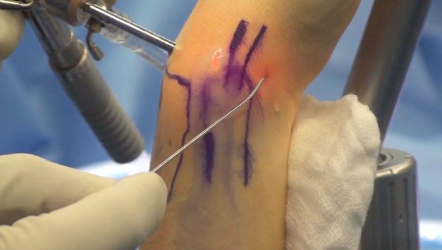 orthobullets's tweet photo. Wrist arthroscopy has important diagnostic/therapeutic roles in wrist injuries but has a 2% complication rate. 1-2 portal is placed b/w ECRB &amp; APL. Care must be taken due to reported injuries to superficial branch of the radial nerve &amp; radial artery. More: https://t.co/wqQswAgZla https://t.co/TO1BhffWRD