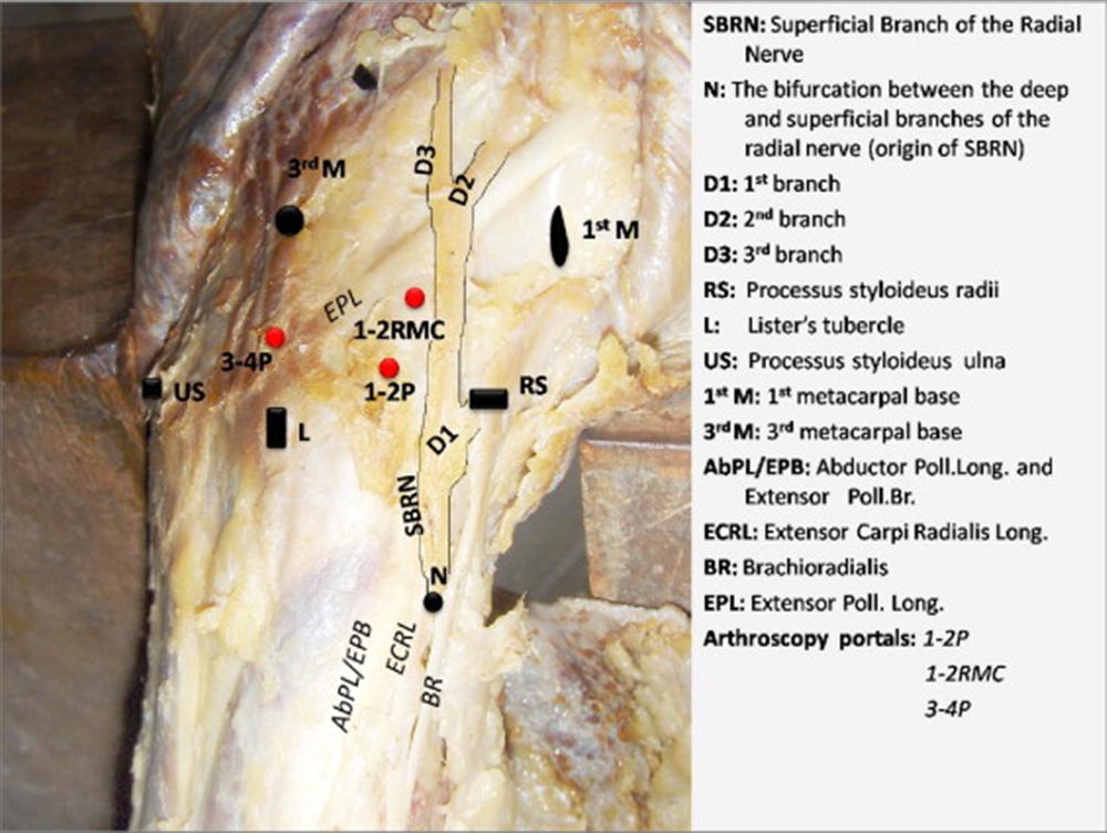 orthobullets's tweet photo. Wrist arthroscopy has important diagnostic/therapeutic roles in wrist injuries but has a 2% complication rate. 1-2 portal is placed b/w ECRB &amp; APL. Care must be taken due to reported injuries to superficial branch of the radial nerve &amp; radial artery. More: https://t.co/wqQswAgZla https://t.co/TO1BhffWRD