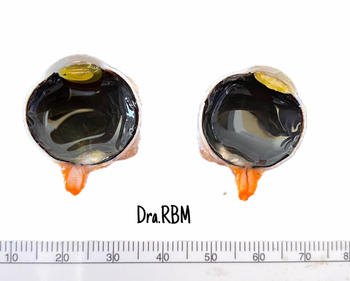 raquelbarron's tweet photo. Retinoblastoma, most common intraocular tumor of children with incidence of 1 per 20,000 live births. Case: a 10-month-old male, enucleation of the right eye. #CasosDra.RBM #Pathology #PathPedia #Path https://t.co/rD8WHn0ylh