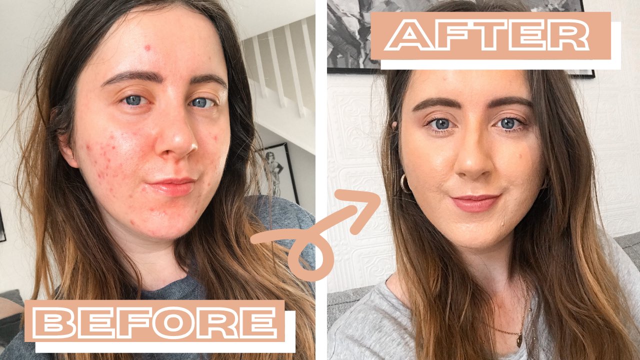 Laura Leanne on Twitter: "HOW TO COVER ACNE | TESTING | ACNE MAKE-UP ROUTINE https://t.co/UxI8FiFa8b #howtocoveracne #acne https://t.co/WAMRbSe282" / Twitter