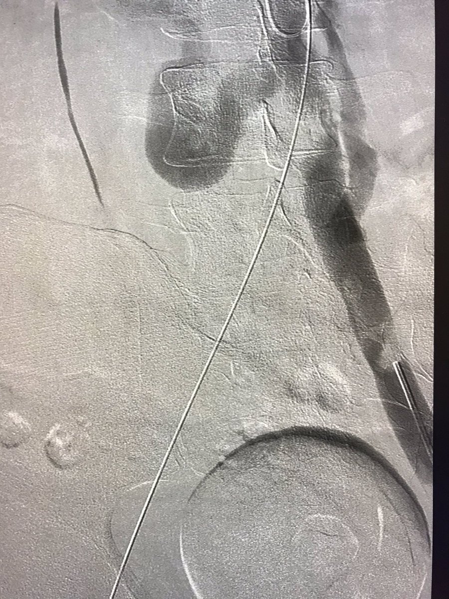 Hailey Carruthers MD (@haileycarruther) on Twitter photo Extensive DVT thrombectomy, evacuated using <a href="/PenVascular/">Penumbra Vascular</a> #lightening CAT12, during which the patient was found to have massive venous collaterals and IVC occlusion 🙀 So #MedTwitter #IRad thoughts...next steps in management? <a href="/SIRspecialists/">Society of Interventional Radiology</a> <a href="/SIRRFS/">SIR RFS</a> <a href="/womenirads/">WomeninIR</a> <a href="/SIRmembers/">SIRmembers</a> Extensive DVT thrombectomy, evacuated using <a href="/PenVascular/">Penumbra Vascular</a> #lightening CAT12, during which the patient was found to have massive venous collaterals and IVC occlusion 🙀 So #MedTwitter #IRad thoughts...next steps in management? <a href="/SIRspecialists/">Society of Interventional Radiology</a> <a href="/SIRRFS/">SIR RFS</a> <a href="/womenirads/">WomeninIR</a> <a href="/SIRmembers/">SIRmembers</a>