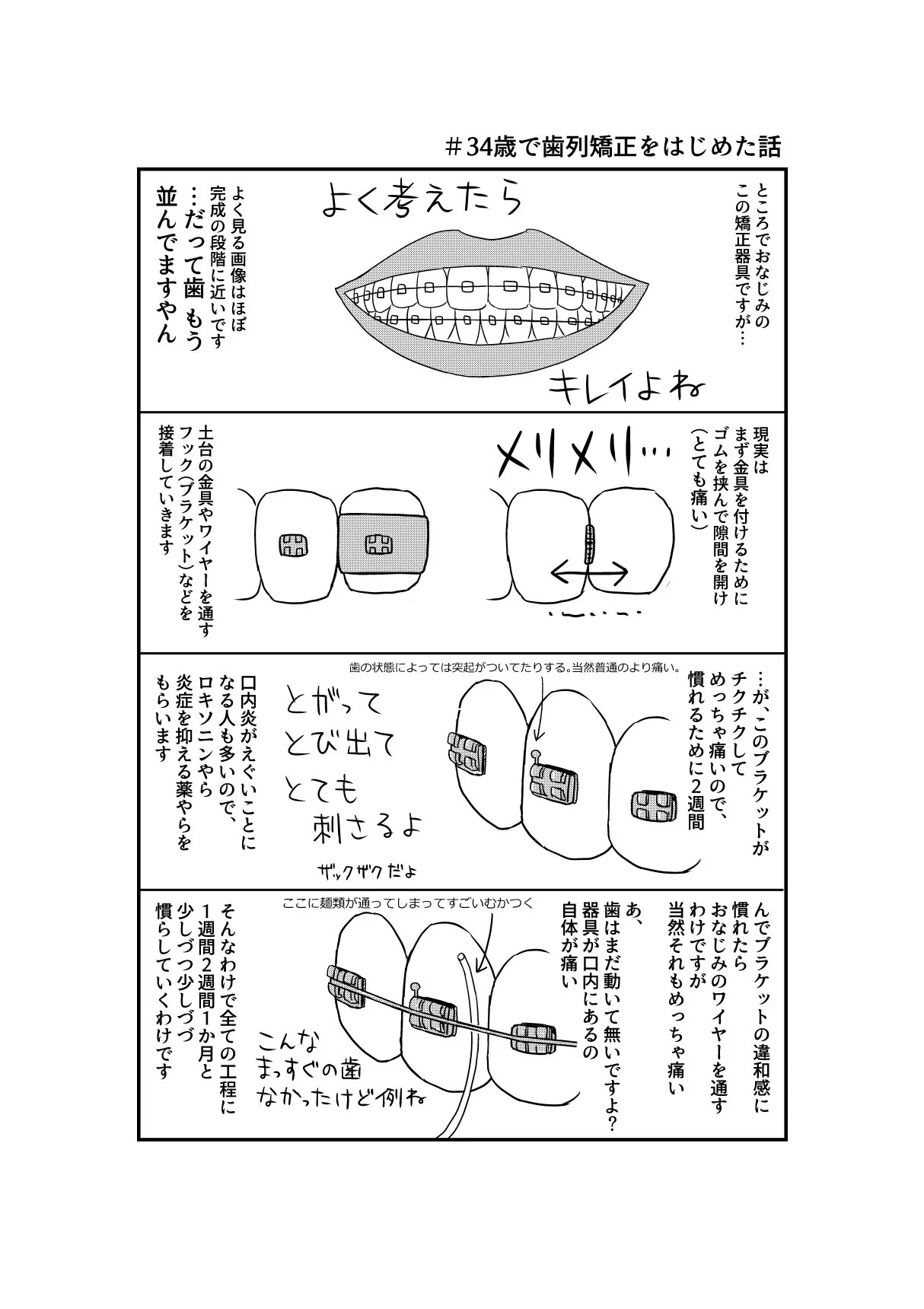 結論から言うと本当にやって良かった。34歳で「歯列矯正」をはじめてみた。