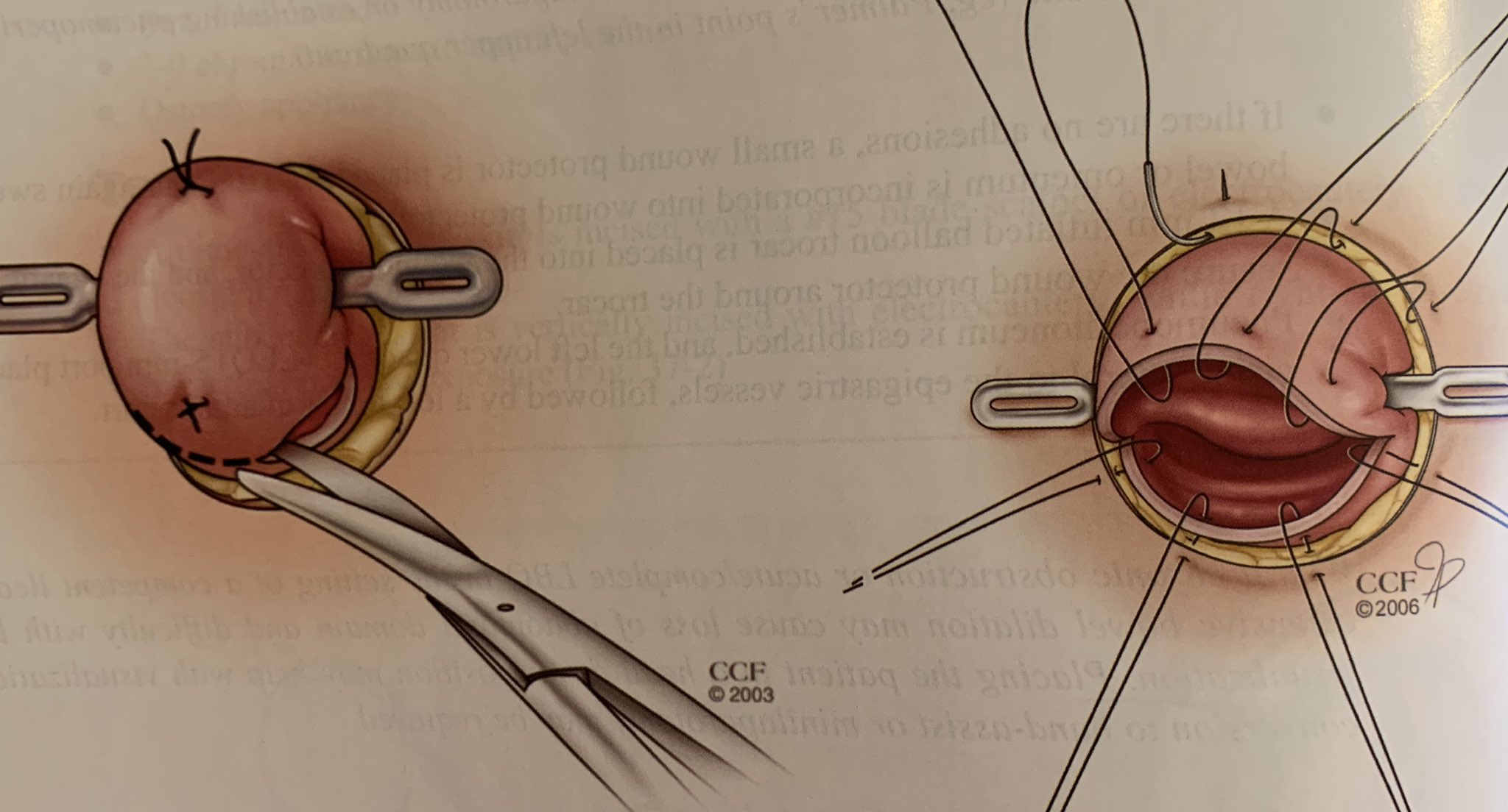 Diverting Loop Ileostomy