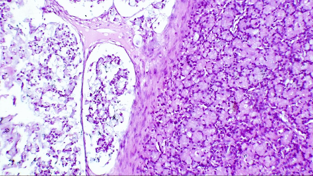 DrNishatAfroz2's tweet photo. Bilateral ovarian masses. 45YF ! Worked up case!! Answer to follow #gynpath #Pathologist #HumanPathology @nucleololailo (don't get scaredππ this time), @nusrat_xahra @kis_lorand @RZitwer @DrFahadAlam @Meghna0630 @pembeoltulu @JNStallMD https://t.co/Y7TgiNN0P3