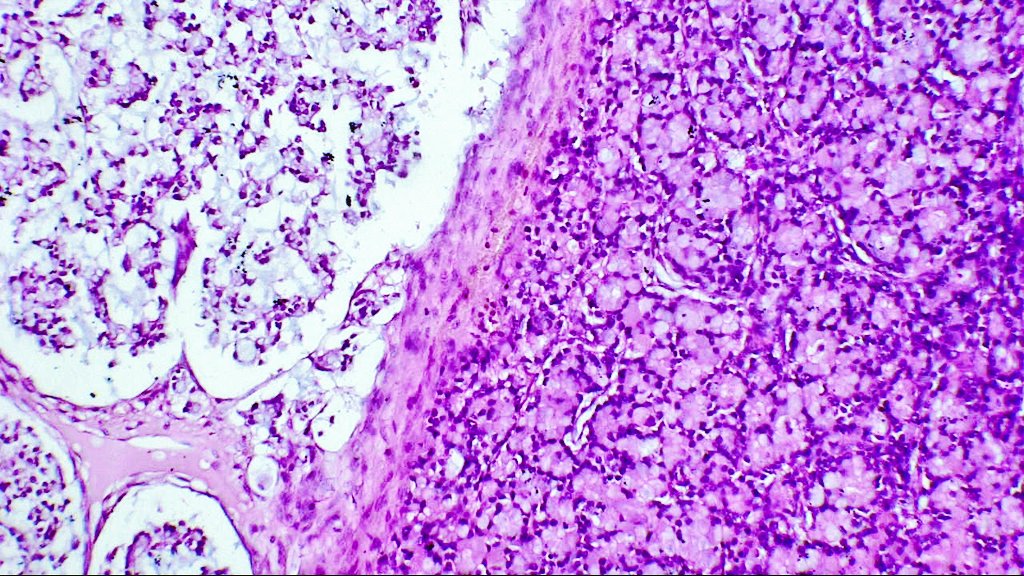 DrNishatAfroz2's tweet photo. Bilateral ovarian masses. 45YF ! Worked up case!! Answer to follow #gynpath #Pathologist #HumanPathology @nucleololailo (don't get scaredππ this time), @nusrat_xahra @kis_lorand @RZitwer @DrFahadAlam @Meghna0630 @pembeoltulu @JNStallMD https://t.co/Y7TgiNN0P3