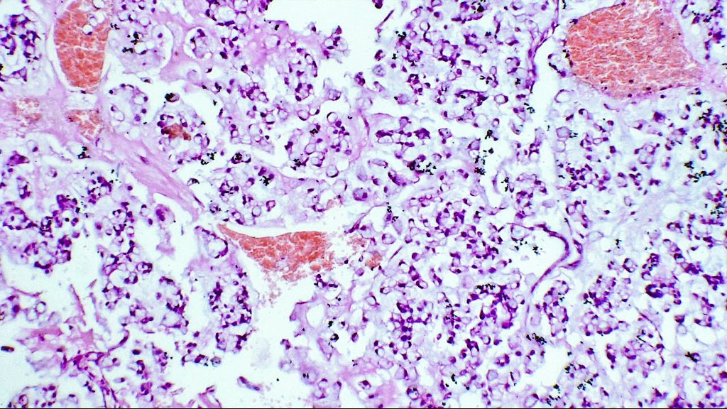 DrNishatAfroz2's tweet photo. Bilateral ovarian masses. 45YF ! Worked up case!! Answer to follow #gynpath #Pathologist #HumanPathology @nucleololailo (don't get scaredππ this time), @nusrat_xahra @kis_lorand @RZitwer @DrFahadAlam @Meghna0630 @pembeoltulu @JNStallMD https://t.co/Y7TgiNN0P3