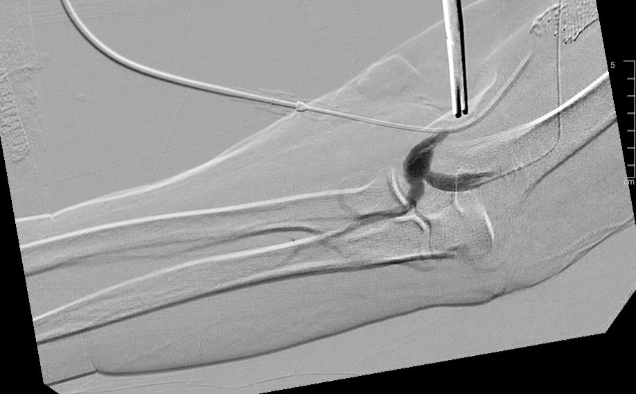 Weill Cornell Medicine Interventional Radiology (@weillcornell_ir) on Twitter photo #IRad consulted for a permcath placement for "fistula issue." #pumpthebreaks and work it up. Pt has had fistula for 10 yrs, now has pain and numbness of the hand with HD. Good thrill on exam. Here are the images.
<a href="/SIRRFS/">SIR RFS</a> what's the main dx and tx? <a href="/SIRspecialists/">Society of Interventional Radiology</a> <a href="/SIR_ECS/">SIR ECS</a> #IRad consulted for a permcath placement for "fistula issue." #pumpthebreaks and work it up. Pt has had fistula for 10 yrs, now has pain and numbness of the hand with HD. Good thrill on exam. Here are the images.
<a href="/SIRRFS/">SIR RFS</a> what's the main dx and tx? <a href="/SIRspecialists/">Society of Interventional Radiology</a> <a href="/SIR_ECS/">SIR ECS</a>