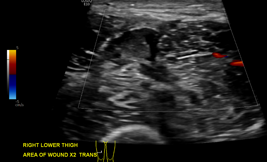 urmed_ir's tweet photo. Stab wound to the thigh with a leaking right femoral artery pseudoaneurysm, successfully coiled. Follow up ultrasound without flow. All done #withoutascalpel and successful stabilization of H/H

#Irad #Interventional #radiology #InnovationToHeal https://t.co/3m0Hzi1kQW