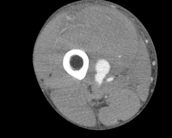 urmed_ir's tweet photo. Stab wound to the thigh with a leaking right femoral artery pseudoaneurysm, successfully coiled. Follow up ultrasound without flow. All done #withoutascalpel and successful stabilization of H/H

#Irad #Interventional #radiology #InnovationToHeal https://t.co/3m0Hzi1kQW
