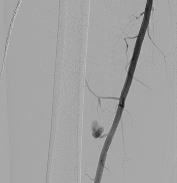urmed_ir's tweet photo. Stab wound to the thigh with a leaking right femoral artery pseudoaneurysm, successfully coiled. Follow up ultrasound without flow. All done #withoutascalpel and successful stabilization of H/H

#Irad #Interventional #radiology #InnovationToHeal https://t.co/3m0Hzi1kQW