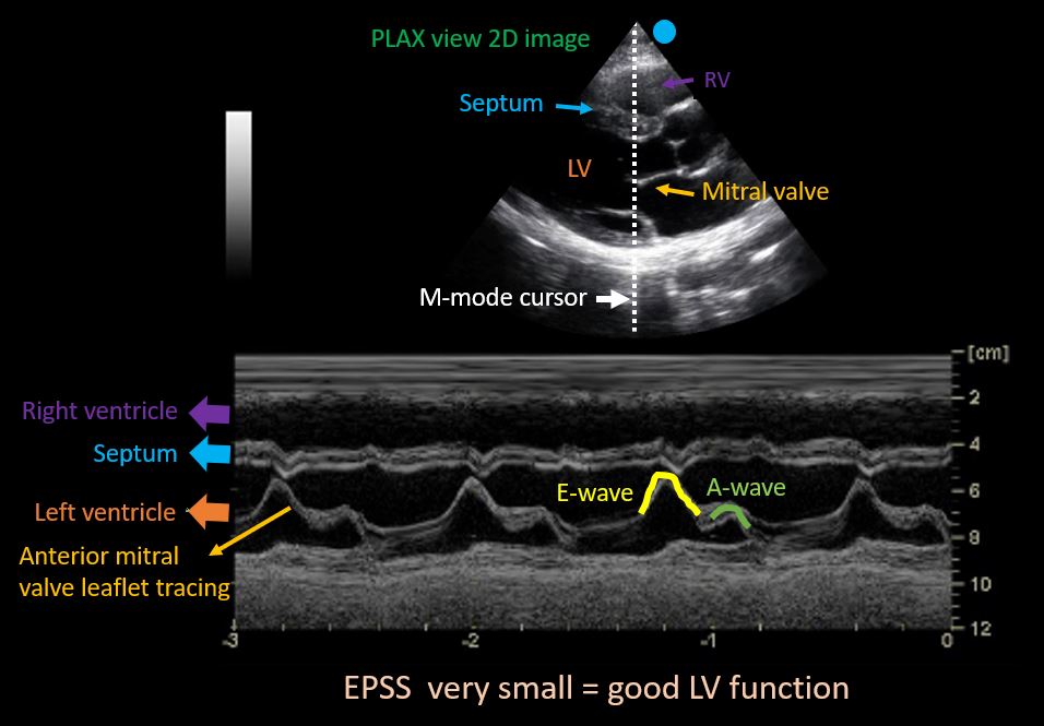E-Point Septal Separation (EPSS) can be used as a simple estimation of LV function. Measure from the ventricular septum to the E-point -- the highest point on the E-wave of the anterior mitral leaflet. "Normal" ≤ 8mm. LVEF ≈ 75.5 - (2.5 x EPSS).
#CincyAI