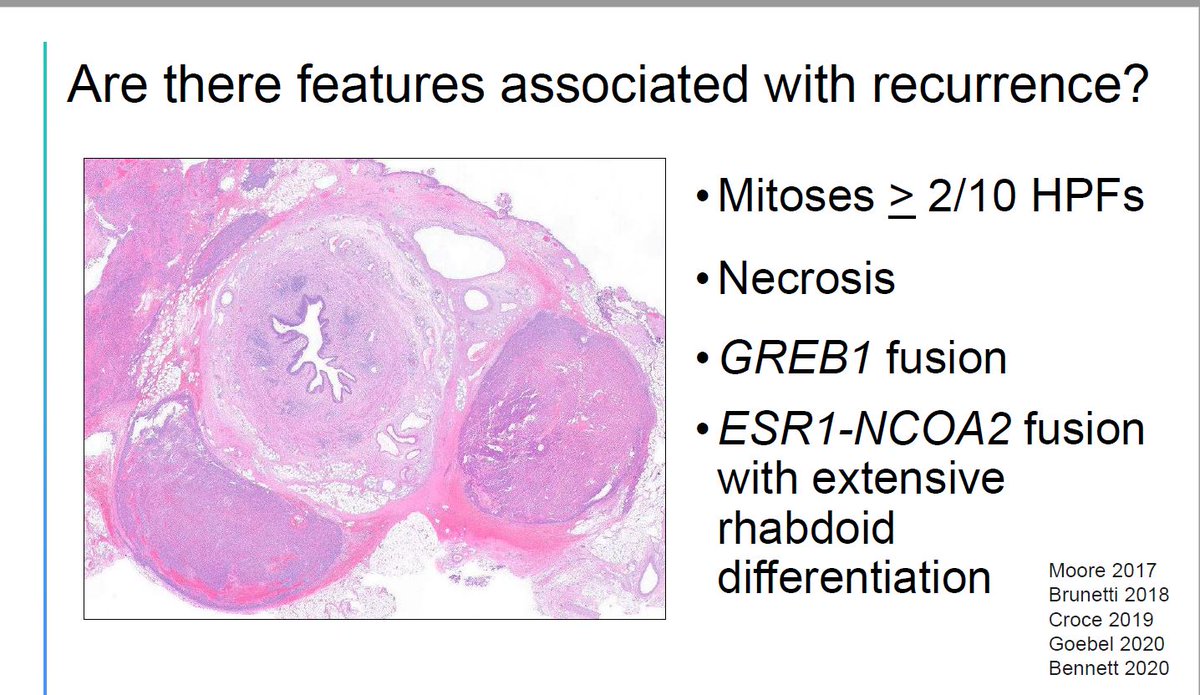 UTROSCT
*⃣Pattern similar to SCTs
*⃣ May be at the base of adenosarcomas
*⃣ ESR1 and GREB1 Fusions 
*⃣ Necrosis, mitoses &gt;2/10, ESR1 with rhabdoid diff, GREB1 fusion: RECURRENCE
#GynPath #GynPathQuiz
Last two photos from Dr Bennett's @pathcast lecture: youtube.com/watch?time_con…