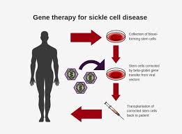   #GeneTherapy is exciting and getting closer to becoming a reality.There are several methods that are being developed to   #CureSCD. To date, # of patients treated is small and follow-up is short, but we& #39;re getting closer. More data needed to show benefits and confirm safety.5/