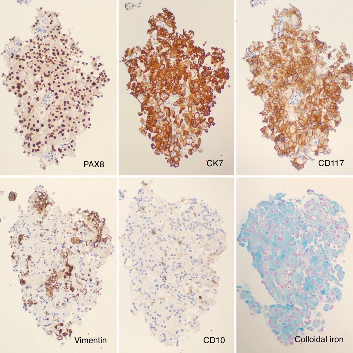 SueEPig's tweet photo. #pathconsult 30F, right renal mass
How would you approach? 🤨🔬#gupath #kidneytumor https://t.co/tef4CrBGm6