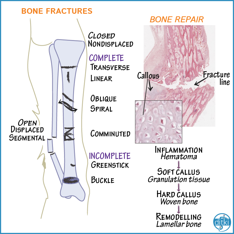 Learn more: drawittoknowit.com/course/patholo…

#ditki #pathology #bonepathology #usmle #meded #highered #medicalschool #medicalscience #medicalstudent #futuredoctor #bonerepair #whitecoat #drawscience #drawpathology #learnscience #pathologyimages #pathologydiagrams