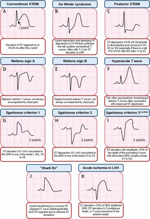 Your patient presents to the lobby with a classic ACS story but the initial EKG doesn't show those contiguous ST elevations you're expecting. Below is a useful graph demonstrating the STEMI-equivalent EKG findings. 
#CincyAI