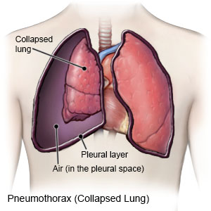 Estando convaleciente presionó y consiguió que le aplicaran pneumotórax artificial, lo cual facilitó su recuperación, regresando a Canadá en 1929. La técnica consistía en llenar de gas el espacio pleural externo al pulmón para que este reposara colapasado.