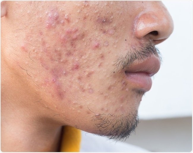 A thread on 10 habits you should stop and what to do instead if you have ACNE/PIMPLES. Whether mild or severe.1. Stop trying a new acne treatment every week or so, because this can irritate your skin and cause more breakouts.[Please RT this thread to inform someone]