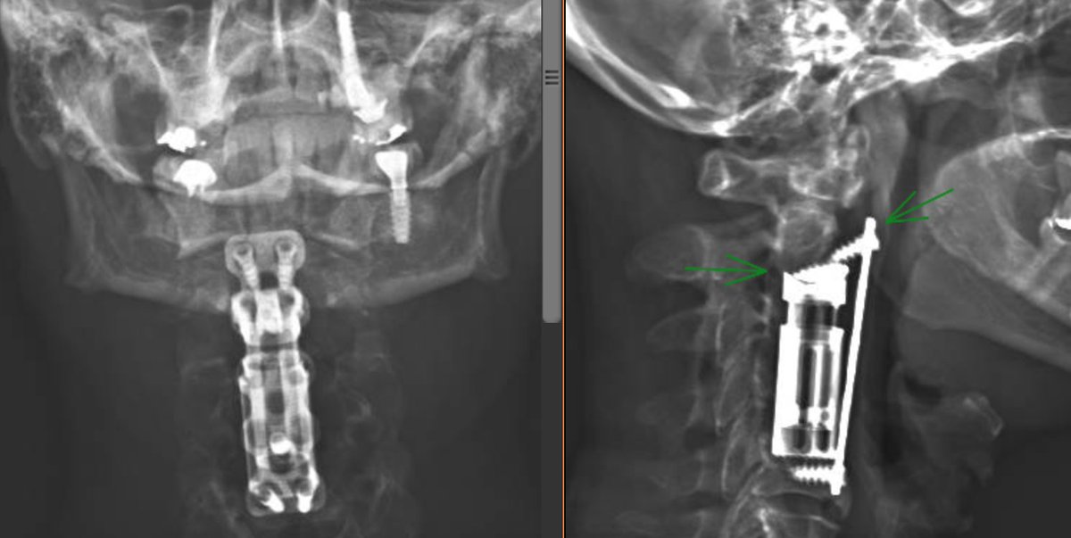 In radiology when you have only one view, you may have nothing

* Spinal fusion hardware failure
Easily missed on frontal view

#MSKrad #radiology #radiologia #orthotwitter