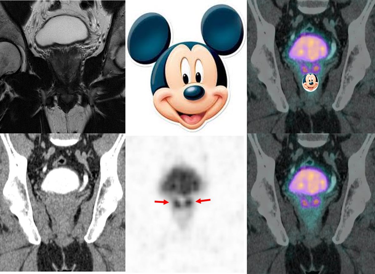 62yo w/ Gleason 6 PCa after TURP. PSA 3,5
mpMR: PIRADS 2
PSMA-PET: 2 focal uptake in central zone (CZ) of prostate.
TRUS Bx: negative 

☢️Teaching point: physiological CZ PSMA uptake (Mickey Mouse ears sign)
✅symmetrical and low uptake
➡️ not commonly seen (pitfall)