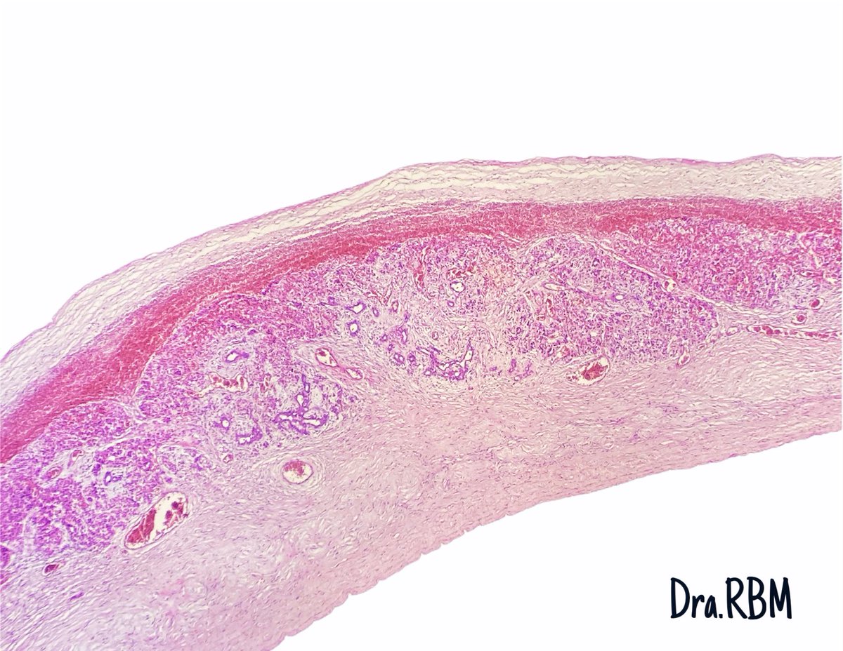 raquelbarron's tweet photo. Hepatic Mesenchymal Hamartoma is the third most common liver tumor in the pediatric age group Case: Female, 3 years old with liver tumor. #pathology #pathpedia #liver #CasosDraRBM https://t.co/Iwep5UbXuy
